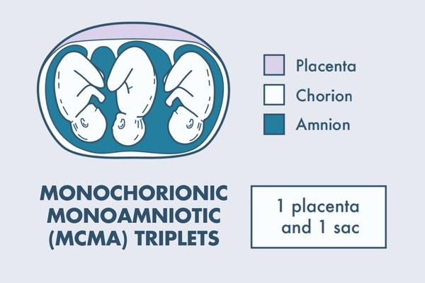 illustration of monochorionic monoamniotic triplets