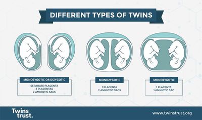 Twin pregnancy identical Antenatal care