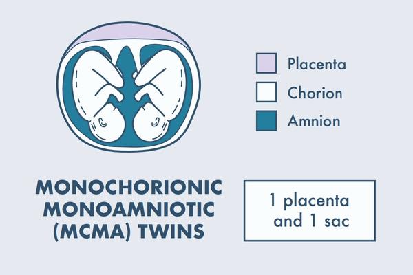 illustration of monochorionic monoamniotic twins