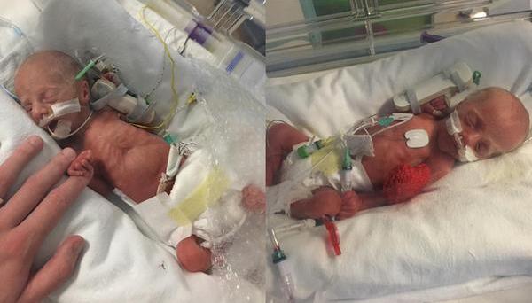 Premature twin babies in neonatal care