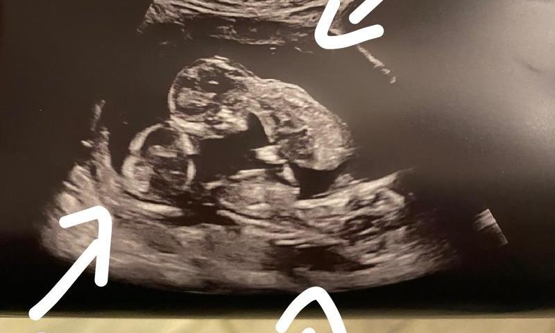 identical triplets ultrasound