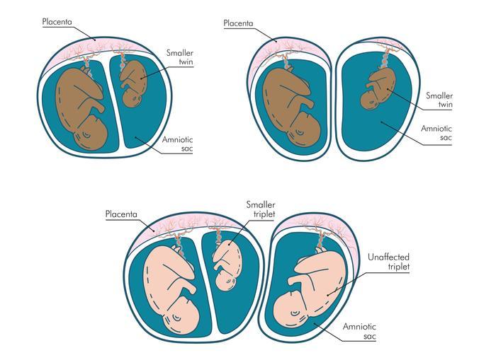 fraternal twins in the womb at 10 weeks